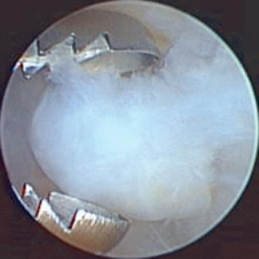 Chapter 24 Arthroscopic Thumb Carpometacarpal Interposition Arthroplasty Placement of Implant The implant insertion technique depends on the type of