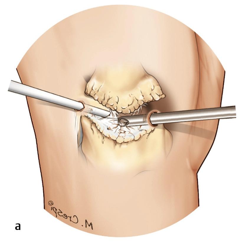 Pyrocarbon Interpositional Spacer For both arthroscopic and open surgery, enough space must be created in the joint to accommodate the implant.