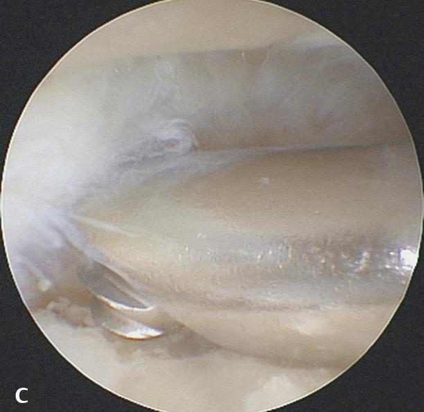 8, 24.9, 24.10a f). Fig. 24.4 Arthroscopic view of an intra-articular foreign body being removed.
