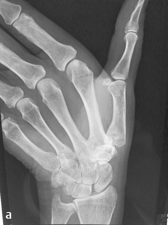 for thumb CMC arthritis is a straightforward technique for patients; it provides