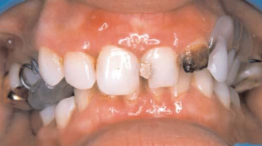 CLINICAL OPTIONS IN TREATMENT PLANNING In this patient with complex oral and skeletal problems we require not only a practical solution, but one that is comfortable and above all esthetically