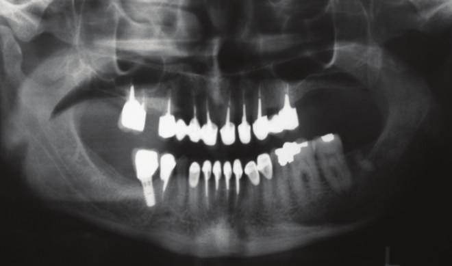 These restorations were fabricated according to the diagnostic waxup (Figure 4), for which the Broadrick flag analyzer was used to determine the curve of occlusal plane.