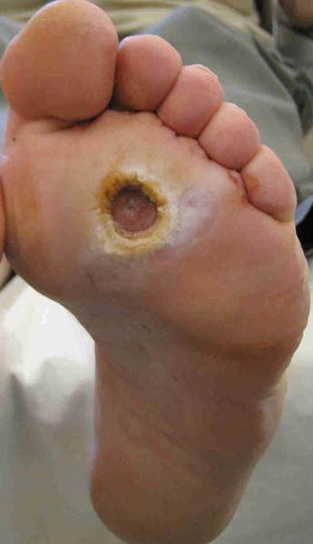 PLANTAR PRESSURE AND FOOT ULCERATION In the presence of neuropathy, elevated plantar pressure is considered one of the most important risk factors of foot ulceration in diabetic patients 24-28.