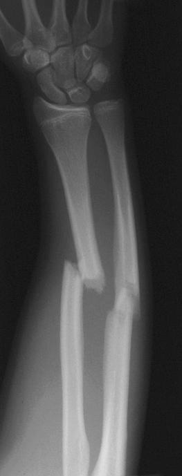 Transverse, midshaft fractures of radius and ulna with complete displacement, shortening and ulnar angulation of the