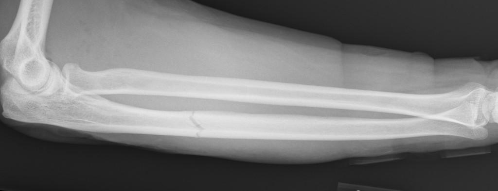 Nondisplaced, transverse fracture of the ulna at the junction of the proximal and middle shaft.