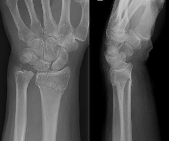 extraarticular fracture of the distal radius with an associated ulnar styloid fracture (Colle s Fracture) When describing