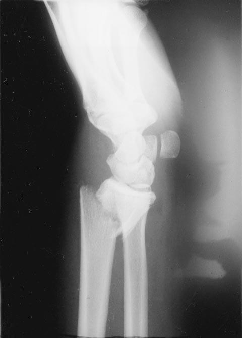 Oblique, volarly displaced, extraarticular fracture of the distal