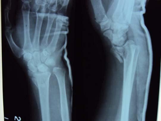 Barton s Fracture Barton s fracture is an intra-articular
