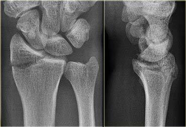 Nondisplaced radial styloid fracture AKA Hutchinson s fracture, Chauffeur s fracture, Backfire fracture The injury is typically caused by