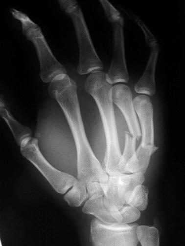 Transverse, angulated, slightly displaced fractures of the 4 th and 5 th