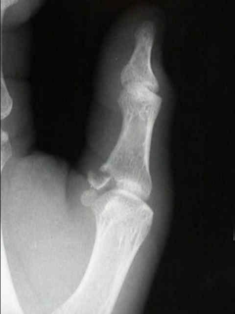Mallet Fracture Splinting 24/7 for 6-8 weeks THUMB MCP ULNAR COLLATERAL LIGAMENT Tear of the UCL of thumb Gamekeeper s thumb Skier s thumb Hyperabduction of the thumb MCP joint Often after a FOOSH