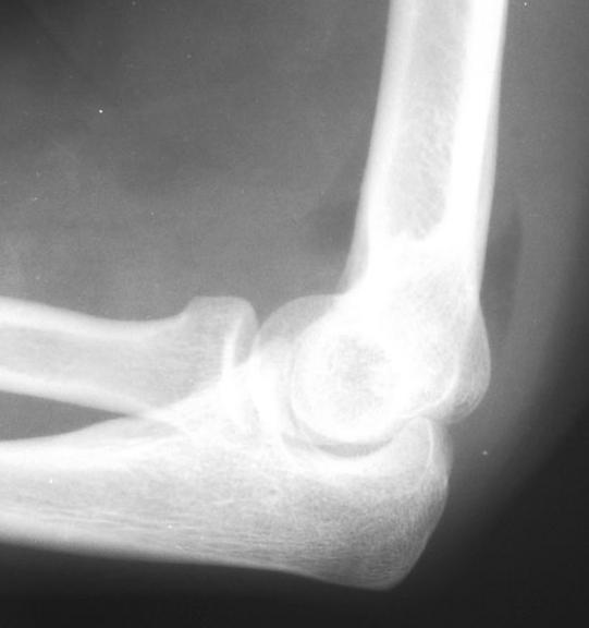 Fat pad sign When fat pad sign is seen, suspect fracture