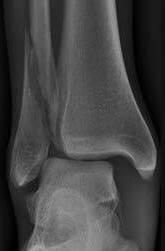 displaced, distal fibular fracture Oblique,
