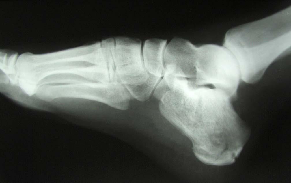 subluxation of the tibiotalar joint and widening