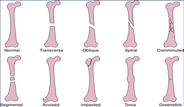 There are many types of fractures including: Nondisplaced fracture Typically stable Displaced fracture Often requires surgery to put the pieces back together Reduction = manipulation of fracture to