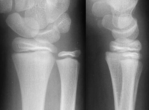 (I-V) SH Type II fracture,