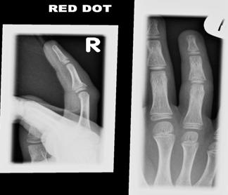 finger SH Type I fracture of the