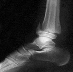 II fracture, distal tibia SH