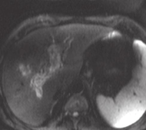 HCC typiclly do not show contrst retention of liver-specific contrst medium in the heptoiliry phse, which cn dd confidence towrd the detection nd chrcteriztion of HCC (Fig. 17.15) [57].
