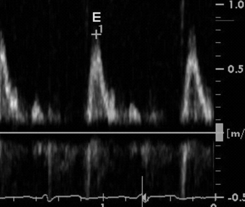 early mitral annular diastolic velocity (Ea - measured by pulsed TDI) has been demonstrated to correlate with left ventricular (LV) filling pressure.