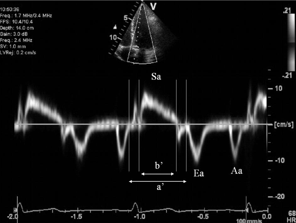 the cardiac apex during systole. The peak myocardial systolic velocity was defined as the maximum velocity during systole, excluding the isovolumic contraction (Sa).