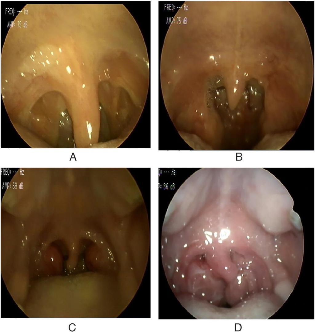 Fig. 3 Brodsky tonsillar grading scale Grade 1: tonsil occupies 25% of the oropharyngeal width to midline Grade 2: Tonsil occupies 26% 50% Grade 3: Tonsil