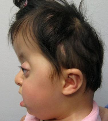 report Apert syndrome