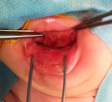 procedures, tongue base reduction and repositioning surgeries, maxillomandibular