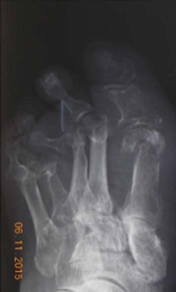 after the treatment in both of soft-tissue and bone infection, while ESR usually remains high only in case of osteomyelitis [30].
