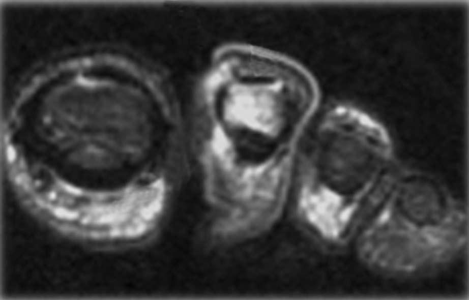 Figure 6 Severe osteomyelitis involving midfoot, hindfoot and ankle detected by magnetic resonance imaging.