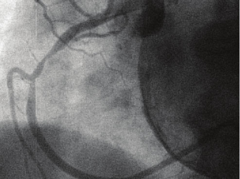 2 (a) (b) (d) (c) (e) Figure 1: (a) Left anterior oblique projection demonstrating right coronary artery (RCA) stenosis and stent implantation.