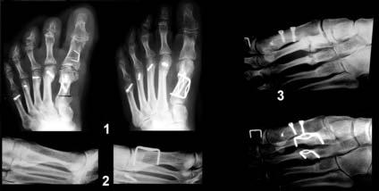 168 Forefoot Reconstruction Use of the 20 Memory Staple in Osteotomies of Fusions of the Forefoot Definition, History, Generalities This staple first provides a permanent compression both in the
