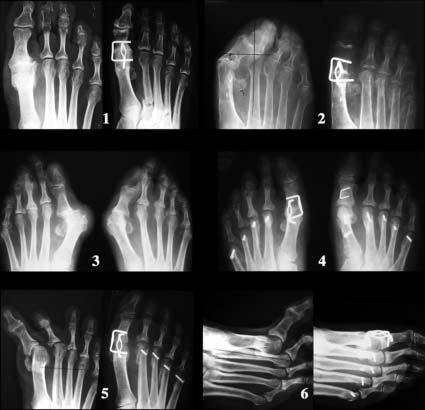 Use of the 20 Memory Staple in Osteotomies of Fusions of the Forefoot 171 Fig. 21b4. First MTP fusion with 20 memory staple. Indications. 1. Hallux limitus. 2, 3, 4. Extremely impaired MTP joint. 2. With hallux valgus.