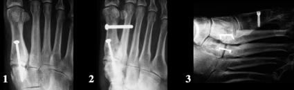 172 Forefoot Reconstruction Fig. 21c1. Lisfranc s fusion. Problems occurring with usual fixation. 1, 2.