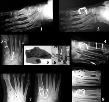 Lisfranc s fusion with the 20 memory staple. 1, 2. Fusion in posttraumatic first cuneo-metatarsal joint. 3.4. Isolated fusion in second cuneo-metatarsal joint. 5.