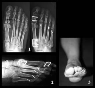 Use of the 20 Memory Staple in Osteotomies of Fusions of the Forefoot 173 Fig. 21c3. Combination of first cuneo-metatarsal fusion and Weil lesser metatarsals osteotomy.