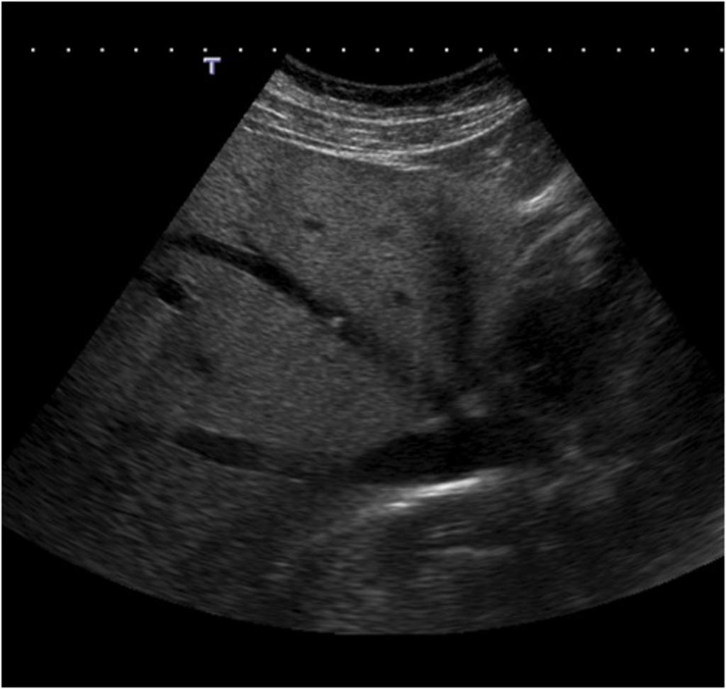 Fig. 6: plain abdominal radiography showing the