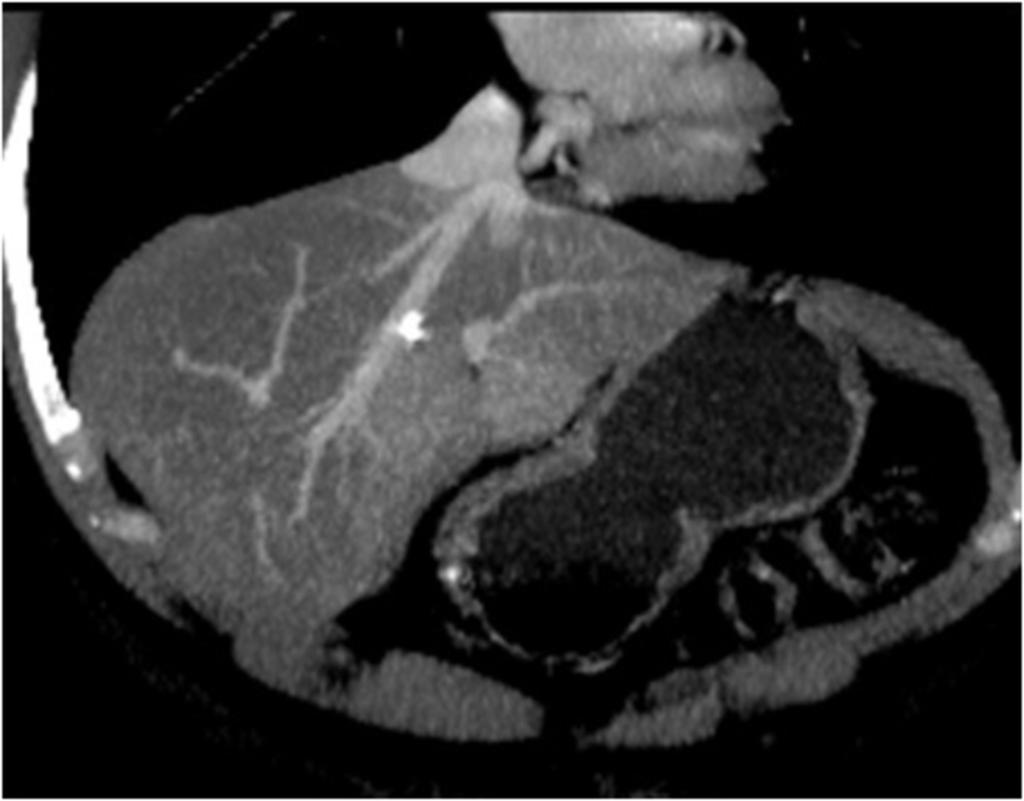 Fig. 8: CT control of the marked metastasis after