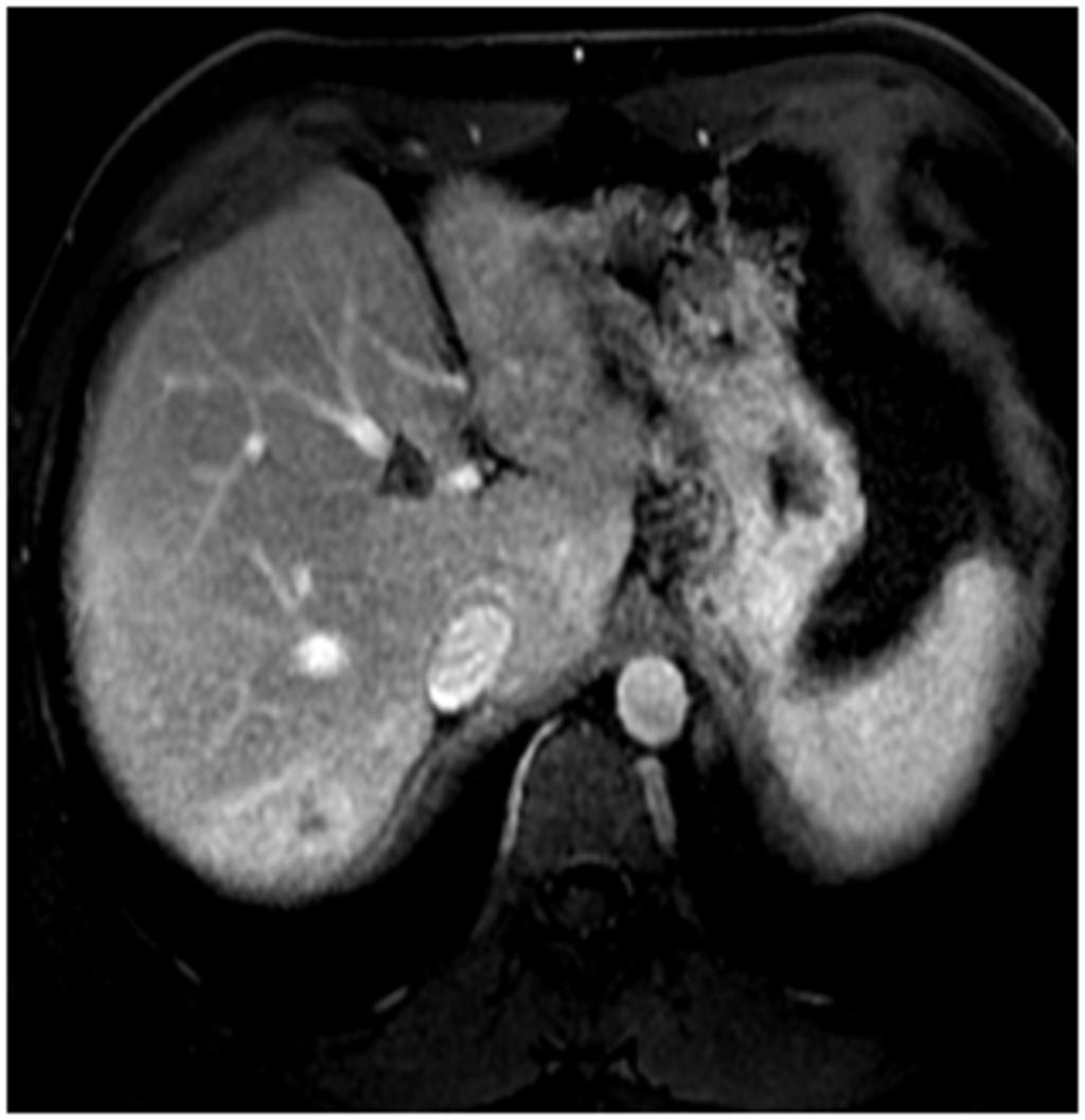 Fig. 9: MRI : before hepatectomy : control of the