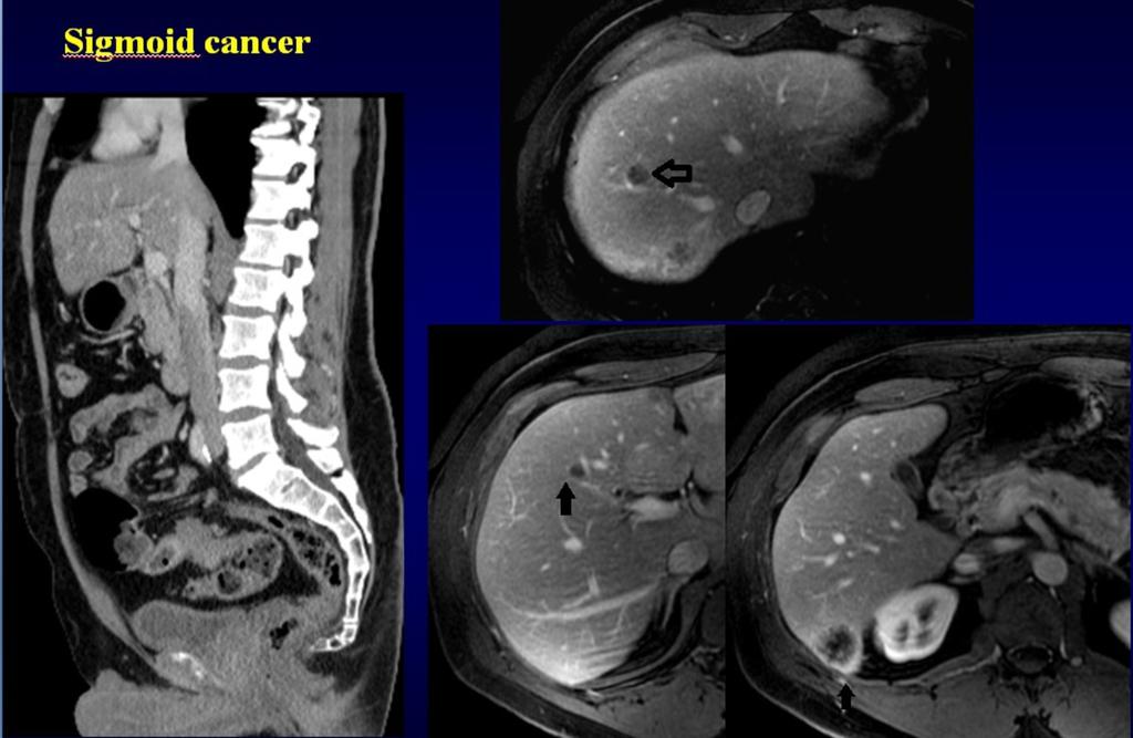 Fig. 1: 47 Y-O male, sigmoid cancer,