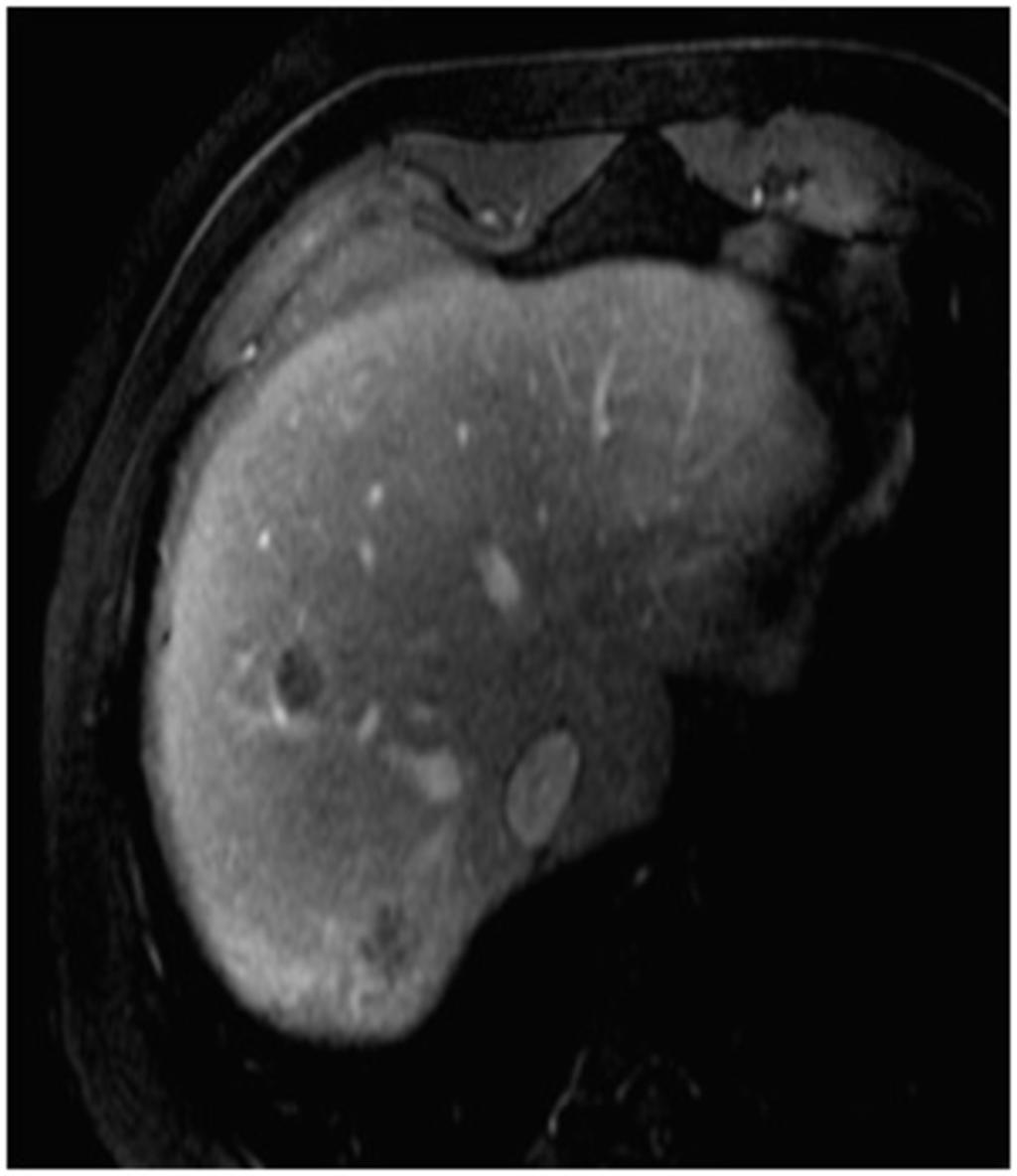 Fig. 4: MRI : liver