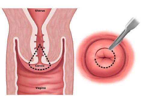 Cervical pre-cancer in U.S. females 1.