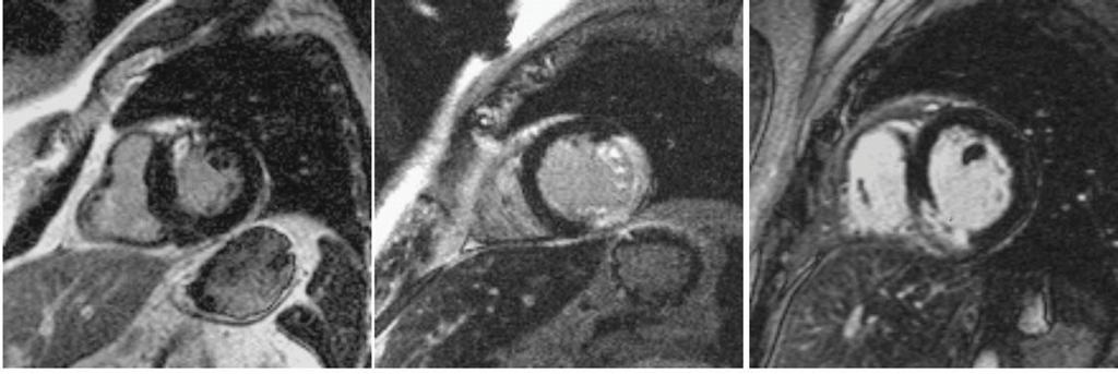 Short-axis DE-MRI images in three patients