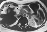 within hemangioma Hemangioma CT Imaging Usually subcapsular region of right lobe Well defined,