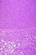 Hepatic Adenoma Histology HA have variable appearance Hypervascular tumors
