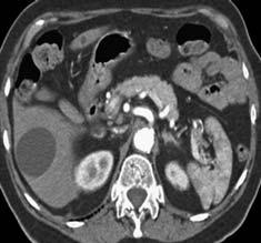 Simple Cyst Diagnosis USG usually sufficient CT and MRI Thin wall Without enhancement Fluid filled No septations Simple Cyst Management Asymptomatic no intervention Symptomatic < 5 cm or