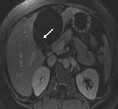 Cyst Adenoma Presentation Cyst Adenoma Management Internal septations Irregular borders Thick stromallayer Calcifications Mural nodules in walls Benign but have potential