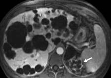 Cysts Polycystic Liver Disease (PCLD) If multiple cysts, consider PCLD Inherited Autosomal dominant Found in association with renal cysts USG, CT or MRI Majority