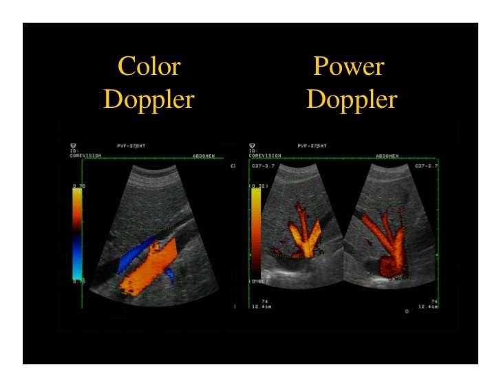 Power Doppler Displays the strength of the Doppler signal in colour,