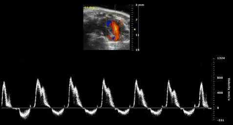 Spectral Doppler Two Types PW stands for pulsed